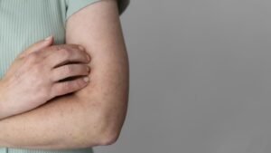 Osoba drapie swędzący łokieć – objawy skórne celiakii i choroby Dühringa, skórna postać nietolerancji glutenu.