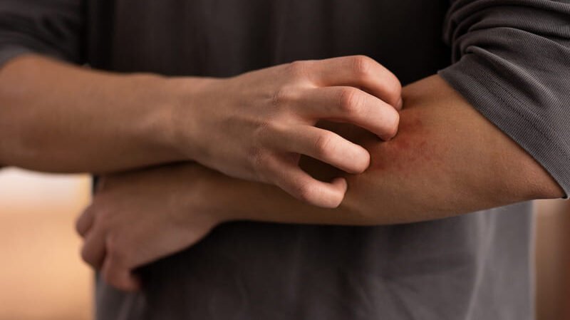 swędząca wysypka na skórze jako możliwy objaw diety bez glutenu